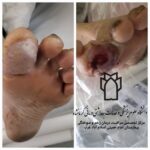 نجات دو بیمار دیابتی از قطع عضو اندام تحتانی در بیمارستان امام خمینی (ره) اسلام‌آبادغرب