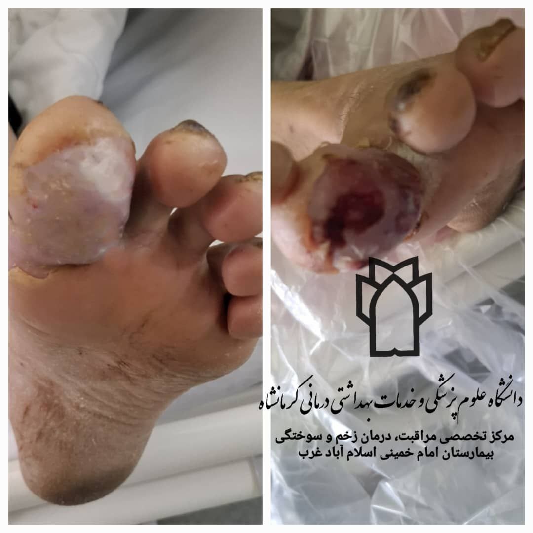 نجات دو بیمار دیابتی از قطع عضو اندام تحتانی در بیمارستان امام خمینی (ره) اسلام‌آبادغرب