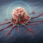 شیوع بالای سرطان‌های گوارش و پستان در کرمانشاه